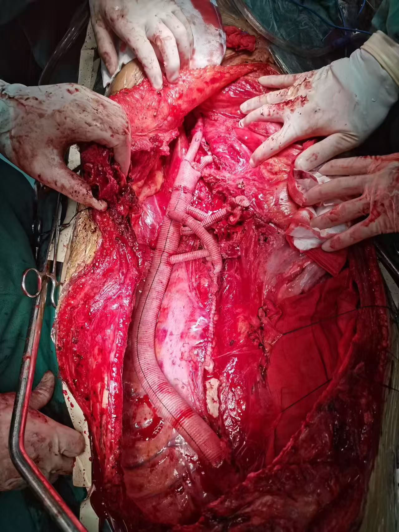 Complex Aortic Surgery image 3