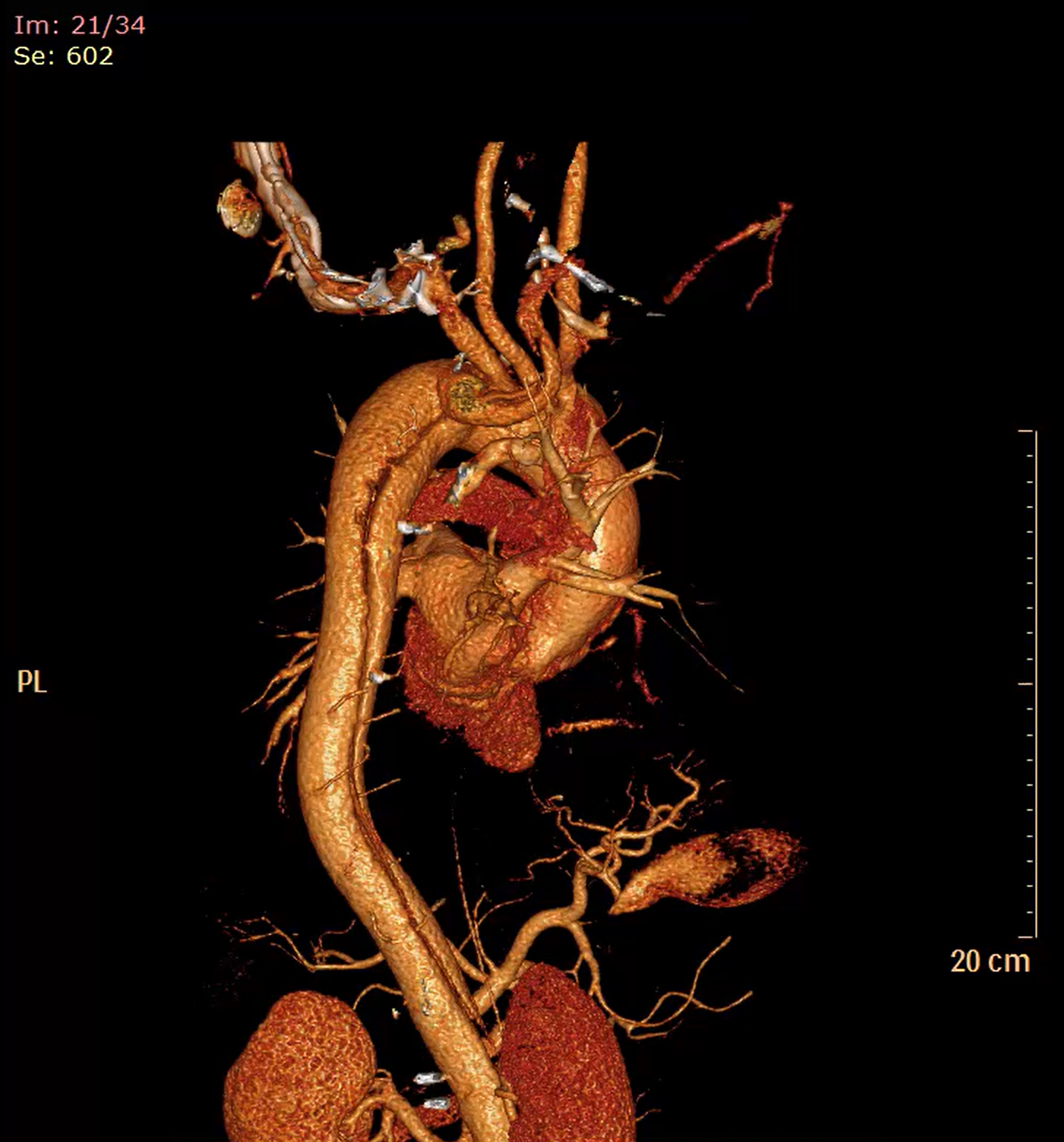 Complex Aortic Surgery supporting image 4