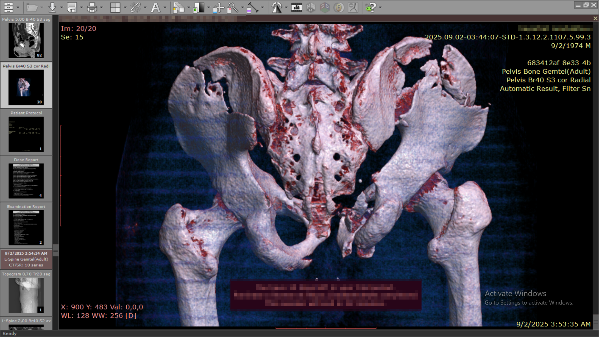 Pelvic Fracture Rescue supporting image 4