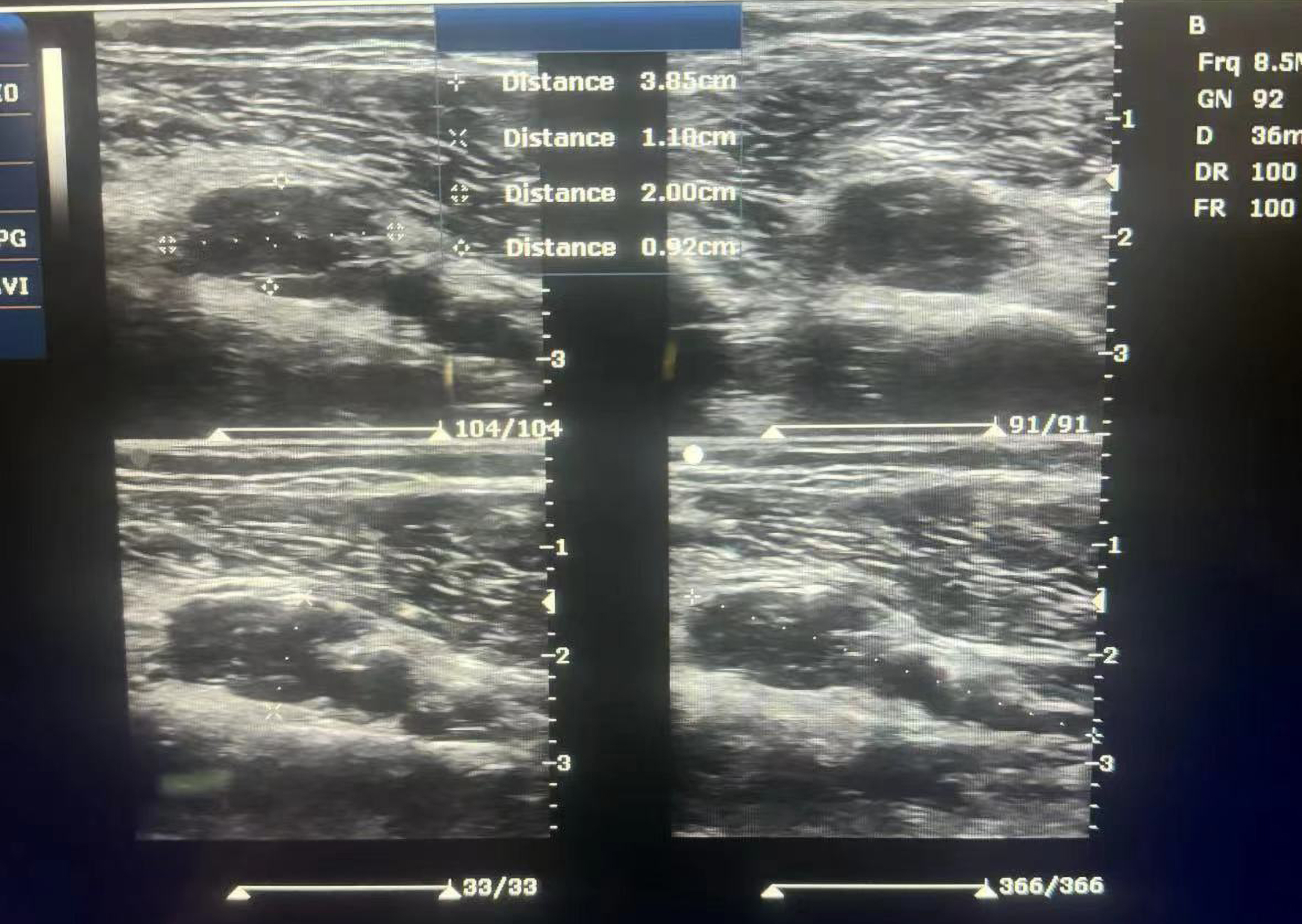 Hemangioma Treatment